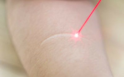 Laser Scar Treatment